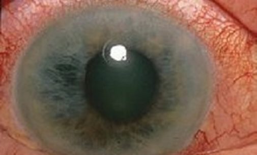PAVIA 17/03/2017: Un semplice esame e non rischi la cecità. Dal 18 al 2 aprile in città il camper di “Prevenire il glaucoma”
